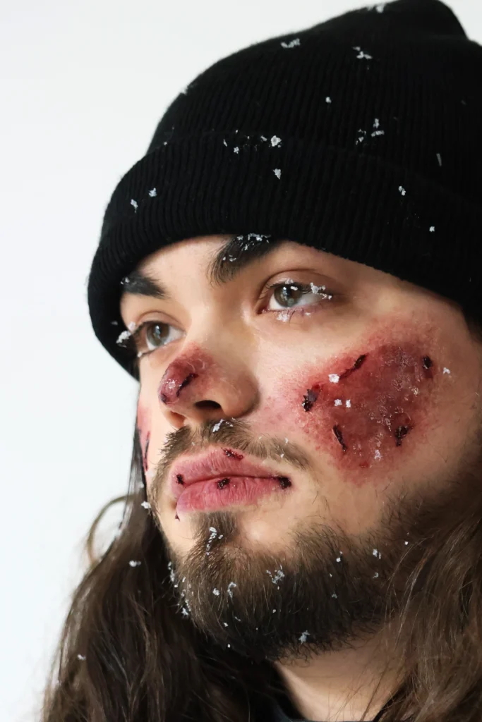 Maquillage FX simulant des engelures et peau abîmée sur le visage