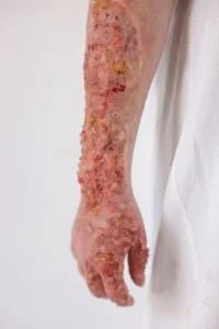 Maquillage d’effet spécial de brûlure grave sur le bras pour shooting photo d'effets spéciaux