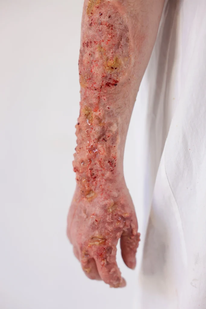 Maquillage d’effet spécial de brûlure grave sur le bras pour shooting photo d'effets spéciaux