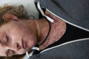 Maquillage SFX simulant des marques de strangulation réalistes sur le cou pour un shooting photo d'effets spéciaux